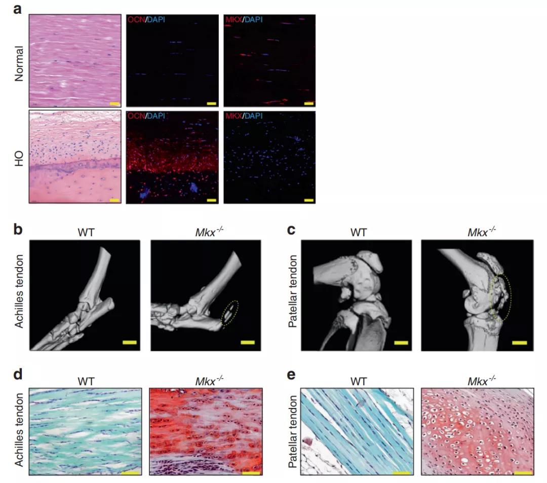 异位骨化的研究进展,肌萎缩侧索硬化症新药研究进展