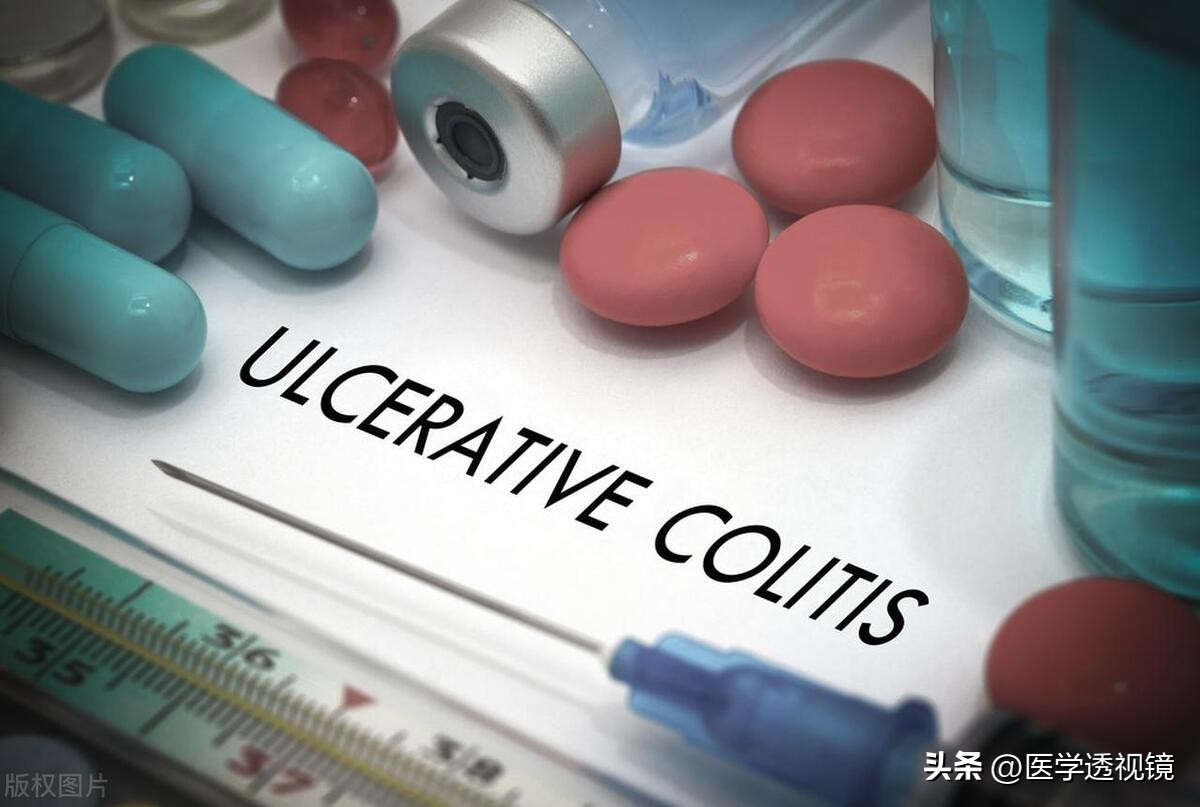 治疗溃疡性结肠炎脓血便有啥办法,溃疡性结肠炎粘液脓血便
