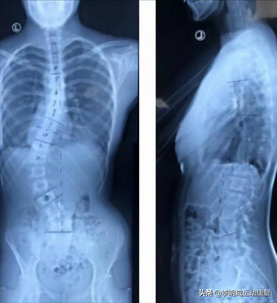 14岁男孩脊柱侧弯怎么训练,14岁女孩脊柱侧弯以后还会加重吗