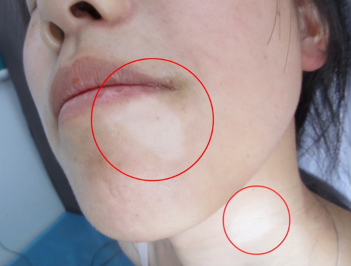 成年人脸部白斑怎么治疗最有效,儿童面部白斑消除最简单方法