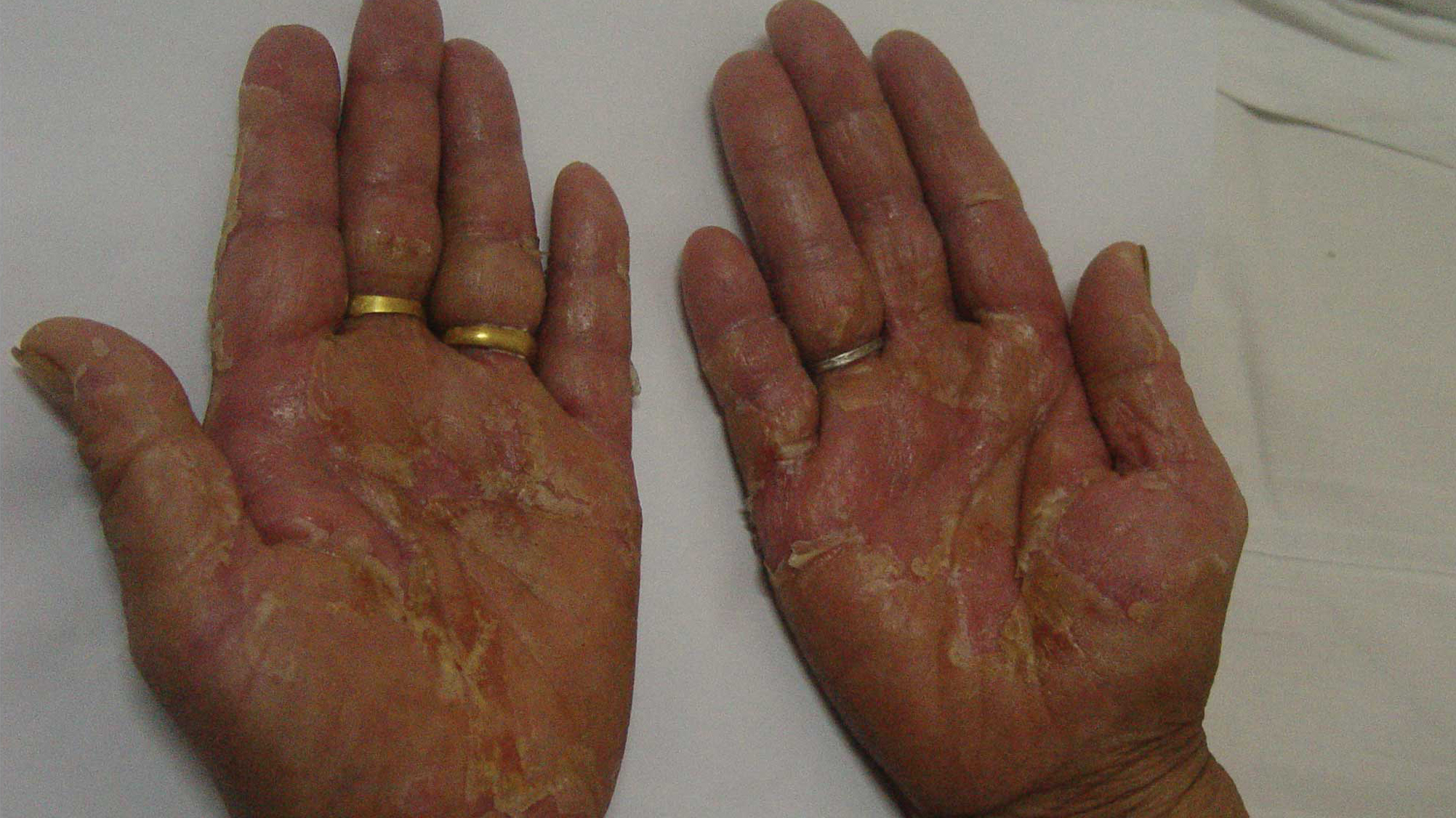 乳房一会侧边疼一会上边疼,乳腺化疗手脚红肿痒怎么办