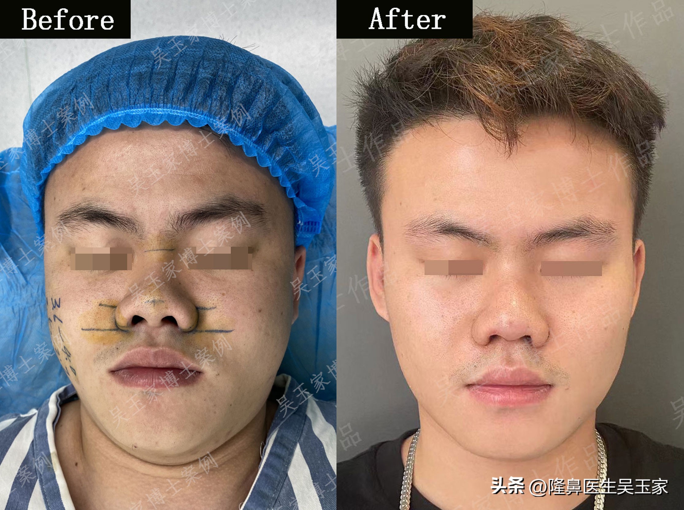 鼻头大整容前后男,鼻头肥大鼻翼宽做手术