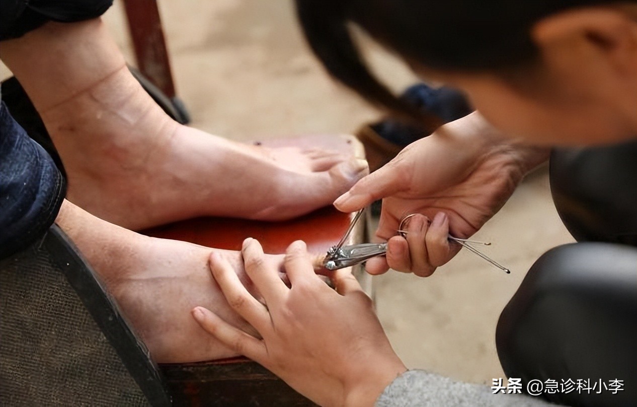 脚趾甲老往肉里长怎么办,甲沟炎脚趾甲往两旁长怎么办