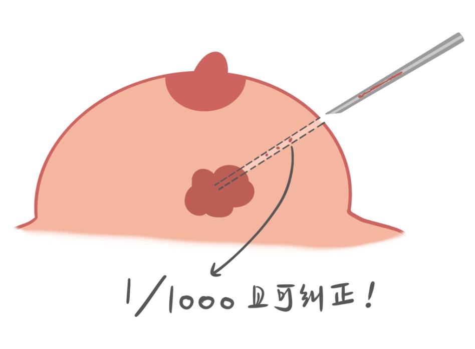 乳房有肿块并且疼痛要做穿刺,为什么医生让做乳腺穿刺