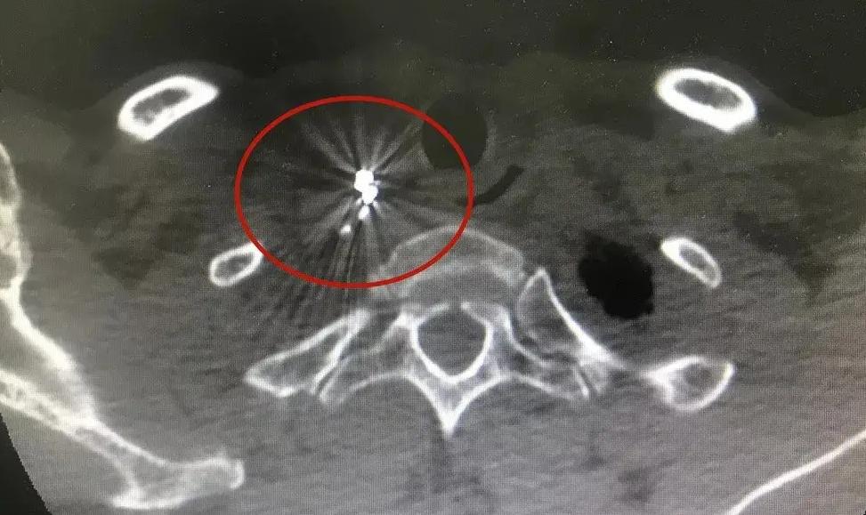 什么是放射粒子植入术？它适合不能手术的中晚期肺癌吗？