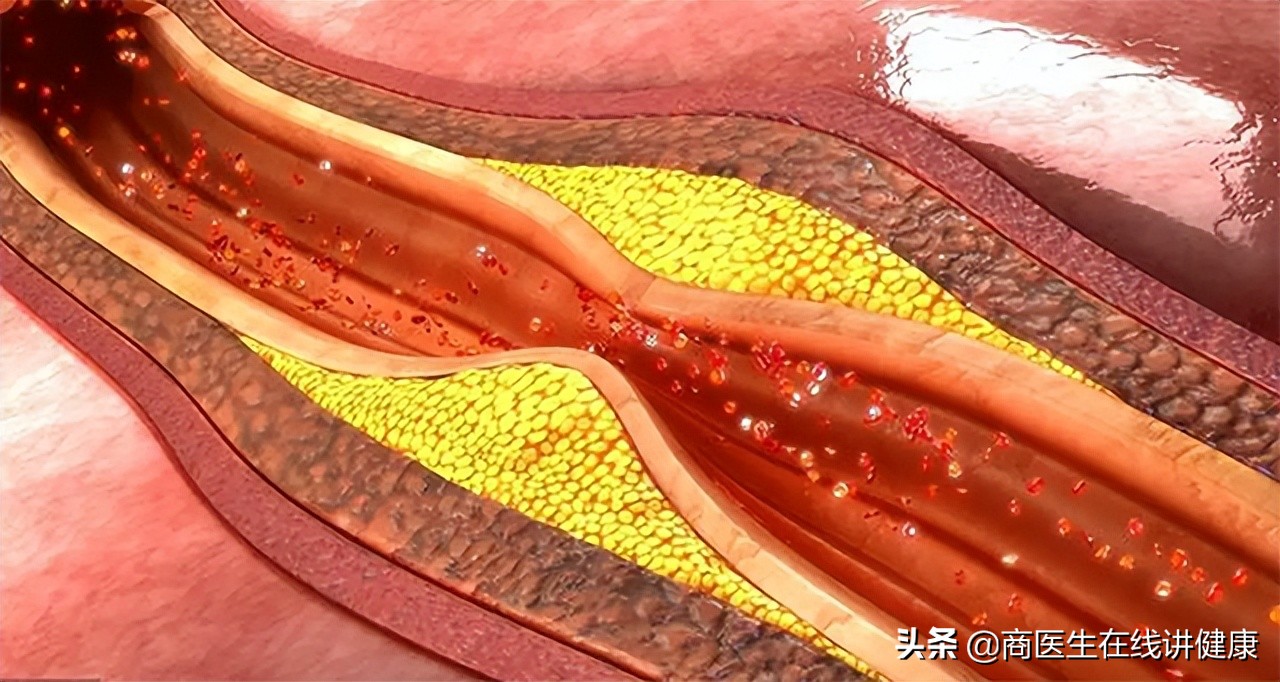 吃花生对胰岛功能的影响,常吃花生对心血管有害吗