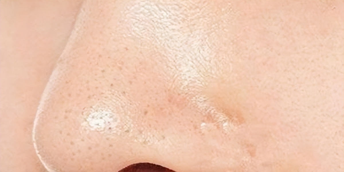 疏通毛孔堵塞的外用药,毛孔堵塞疏通的有效方法