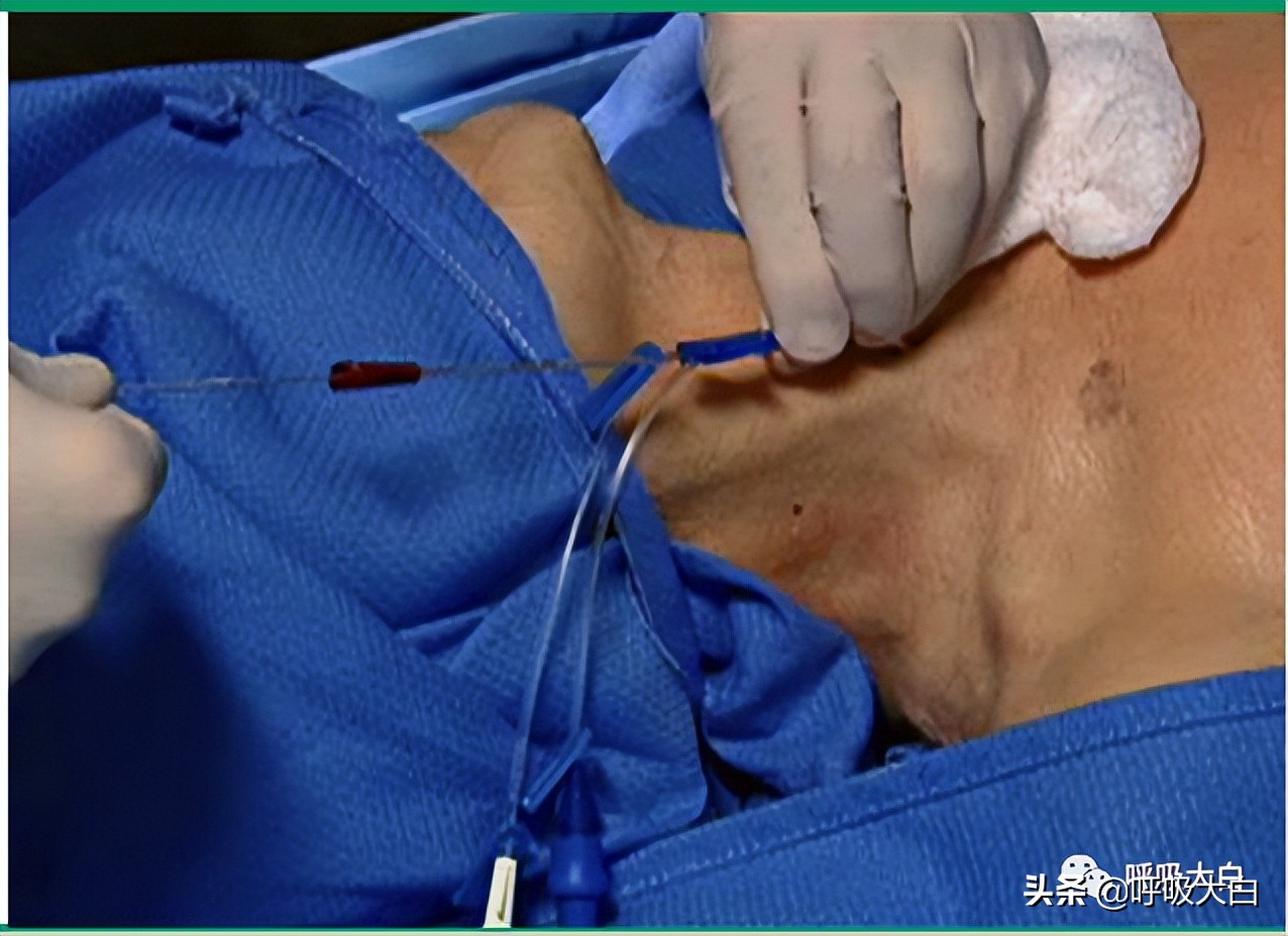 中心静脉导管置入术的步骤,颈内静脉导管拔除注意事项