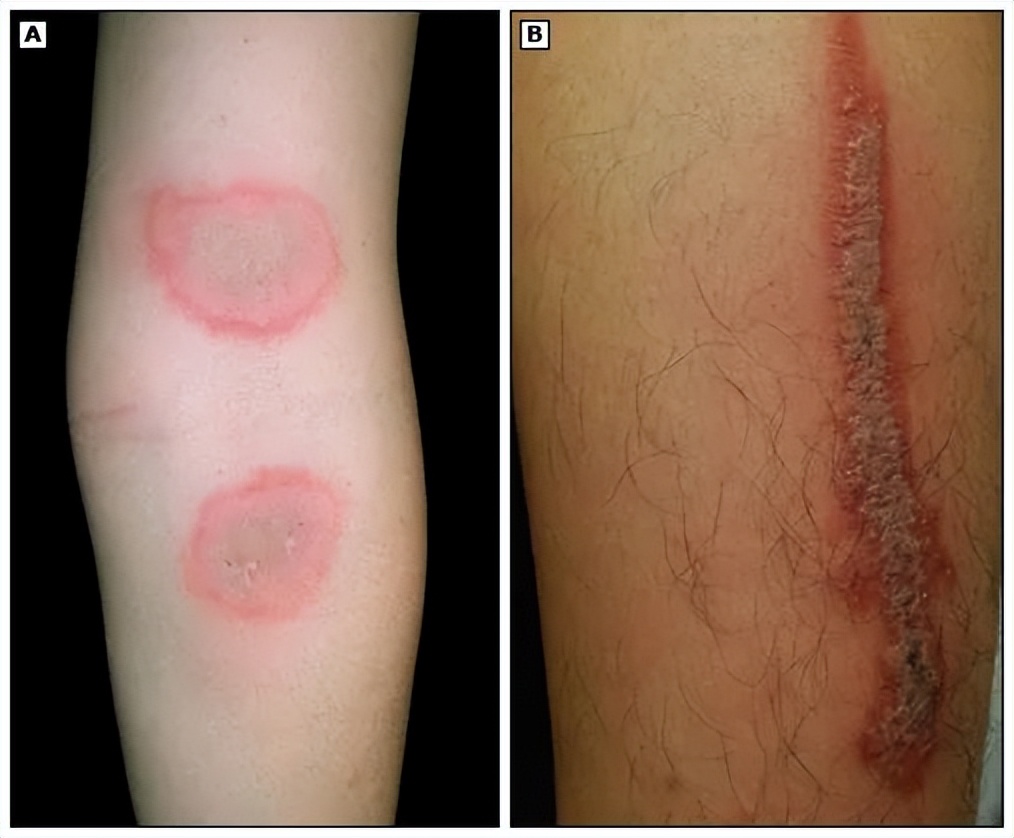 夏日带孩子户外活动当心这种虫,暑期带娃小心毒虫