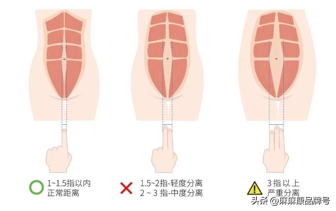 产后腰痛、腹部松垮？一文教你自测与修复腹直肌分离
