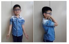 肱骨骨折取钢板怎样恢复,肱骨近端骨折切开复位内固定术