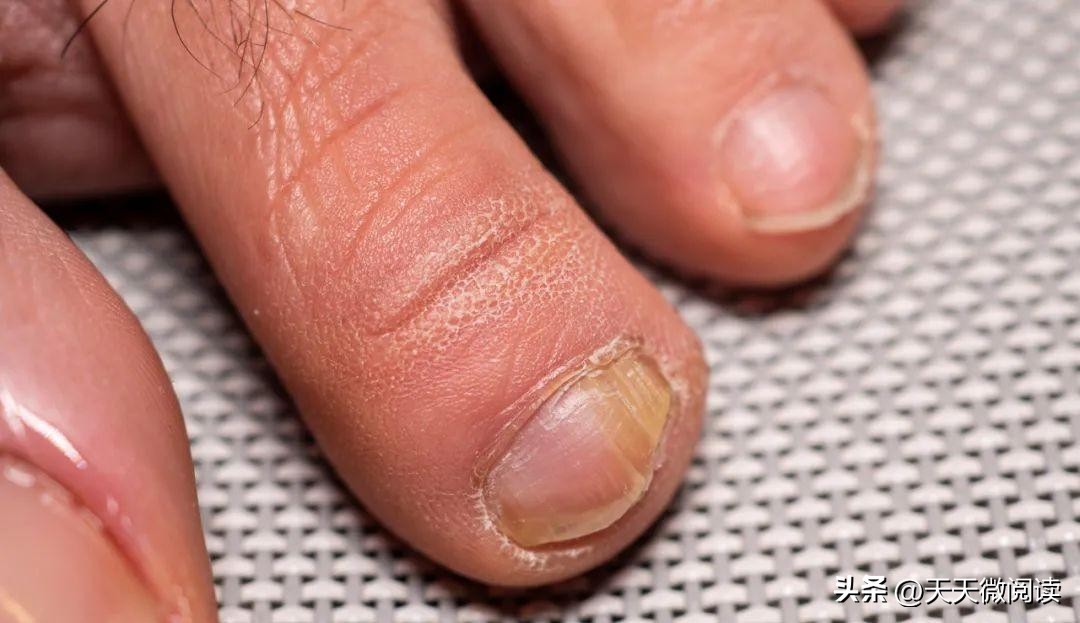 大拇指甲上有白色竖纹是怎么回事,左手大拇指指甲有黑竖纹怎么回事