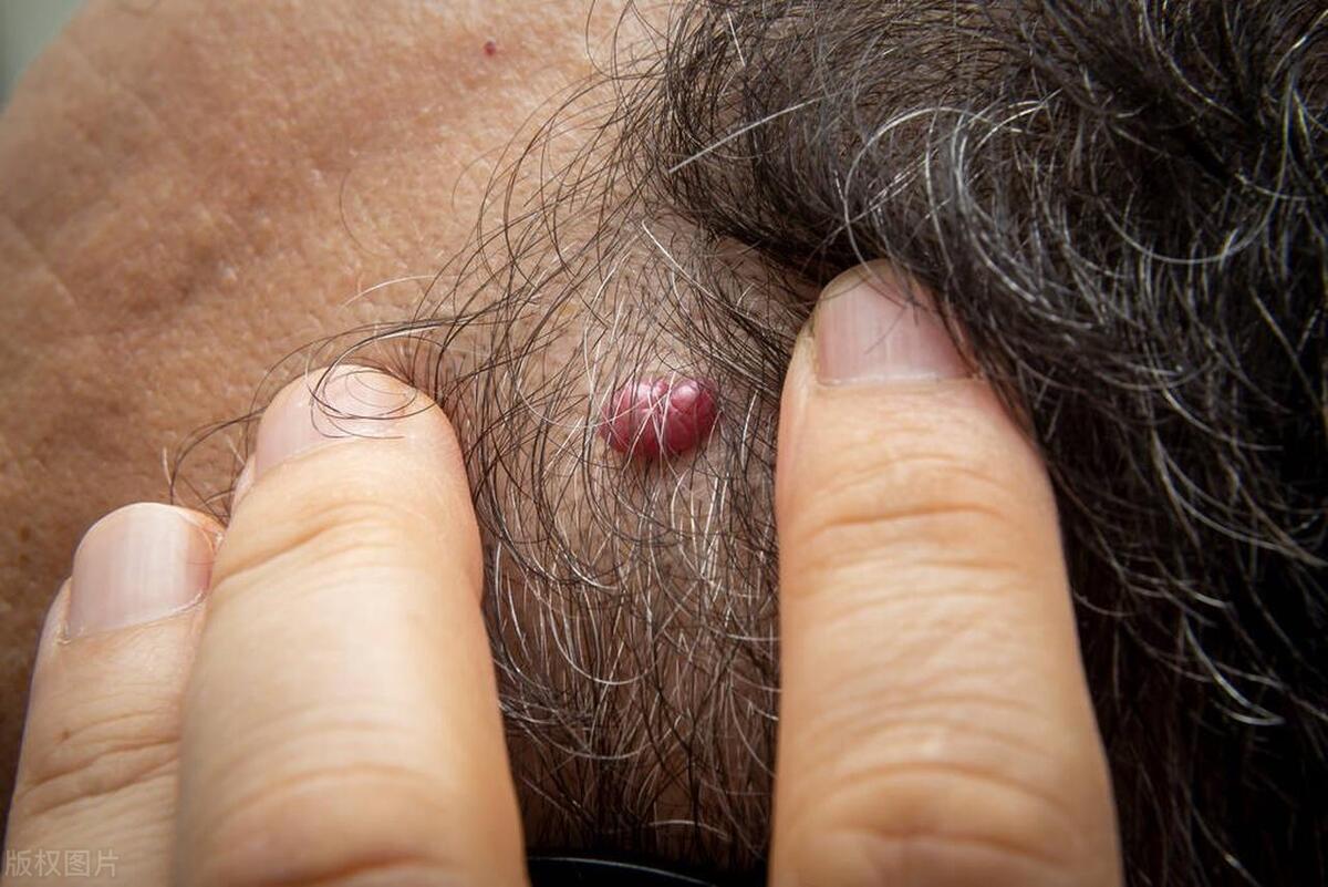 皮肤长小肉球是什么症状,皮肤长小疙瘩小肉球怎么弄