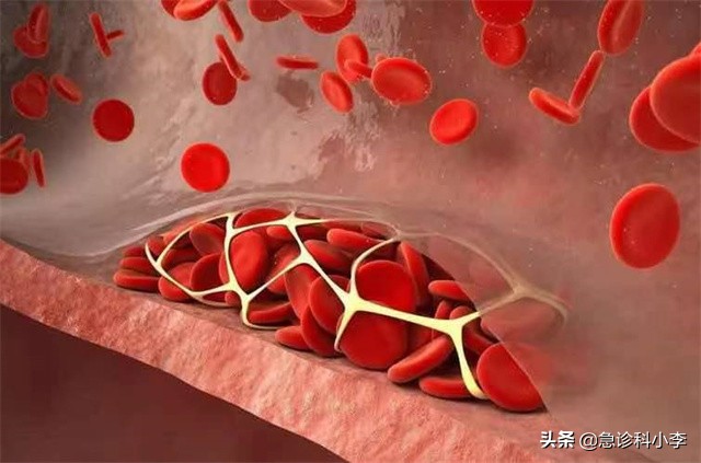 医生血脂化验单,医生一步一步教您看血脂化验单