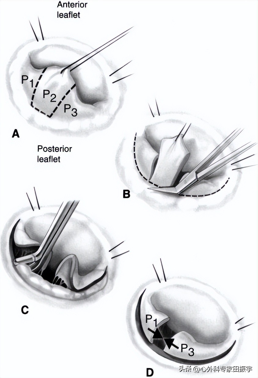 二尖瓣成形术,二尖瓣成形术后需要静养多久
