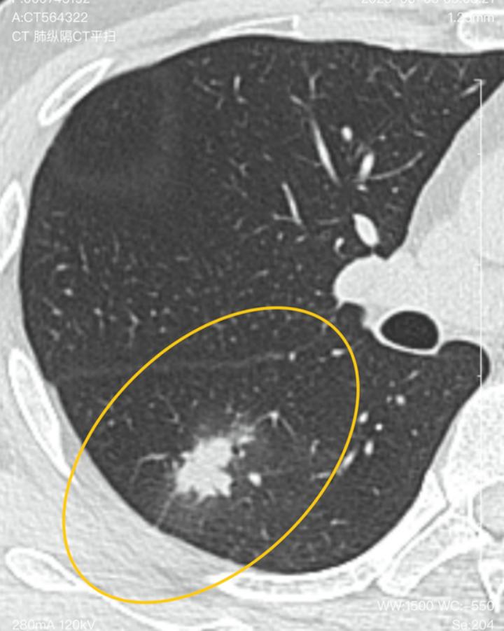 8mm肺结节一般几年转癌,8mm肺结节一年后没了严重吗