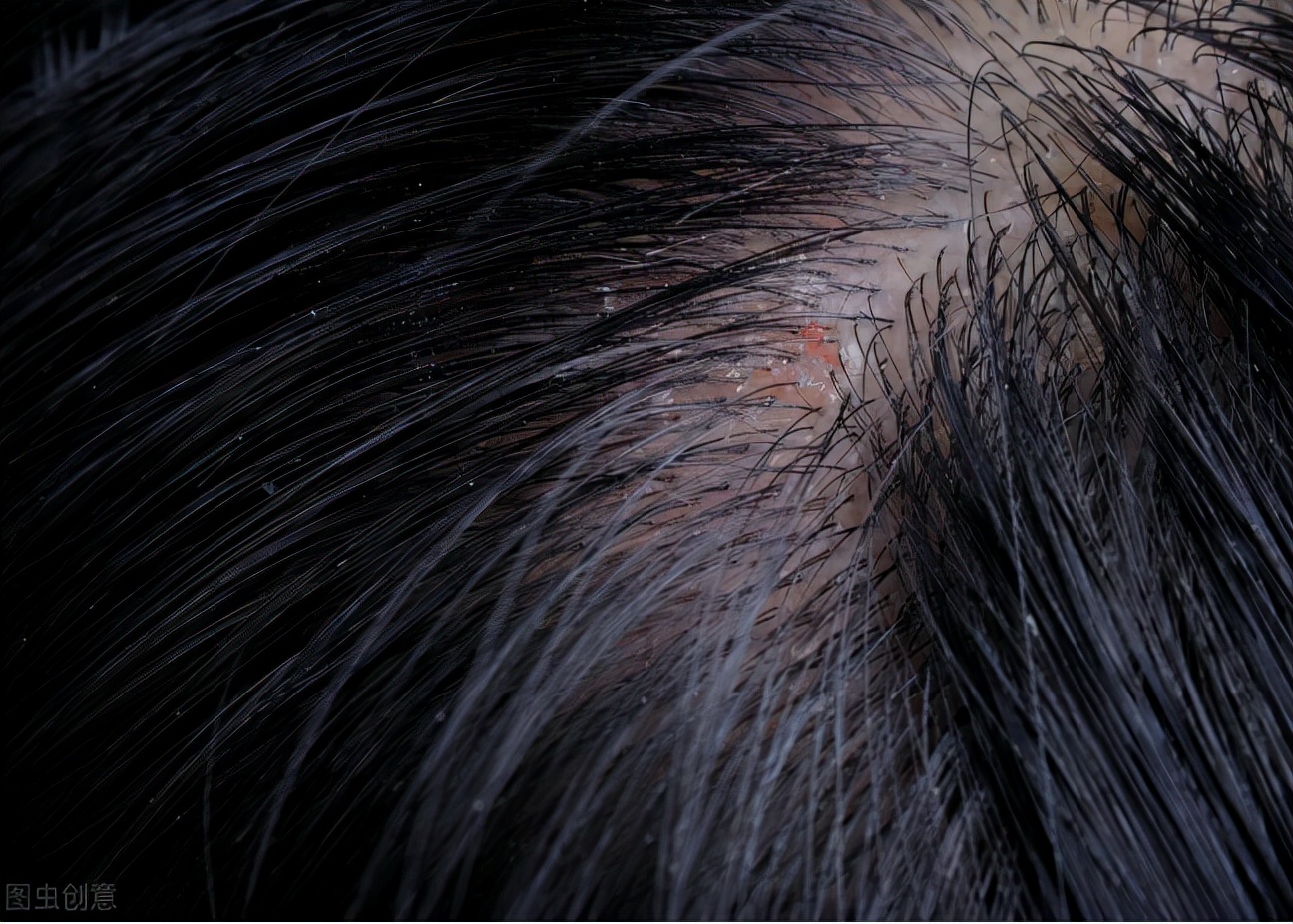 中年人头皮屑多是什么原因,中年头屑多是什么原因