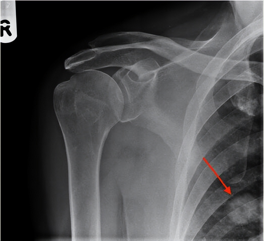 老人摔倒拍片骨头没事就是感觉疼,老人摔倒后肩膀疼痛怎么办