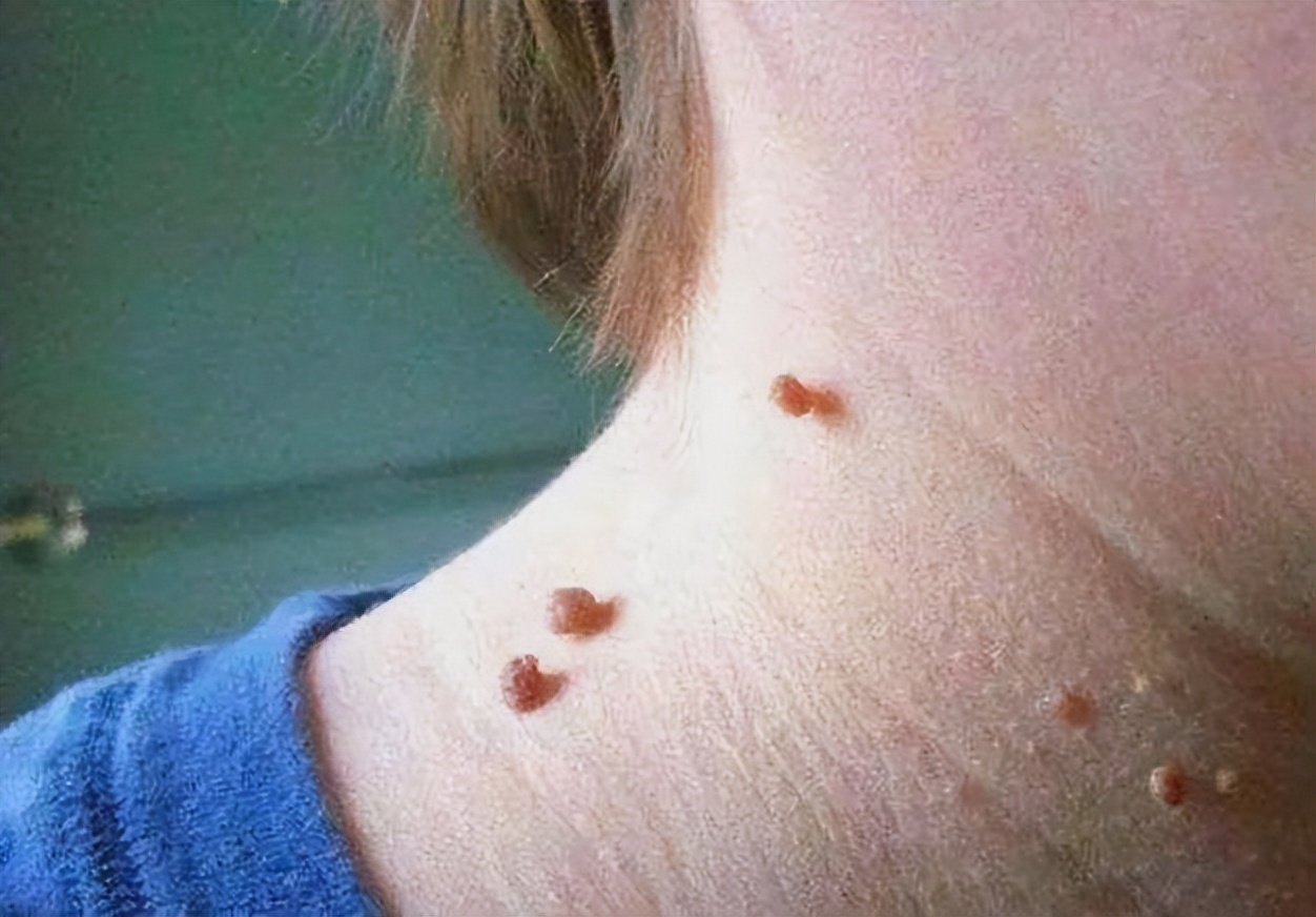 脖子和腋下的小肉粒可以揪了吗,脖子上的小肉粒揪掉后会怎样