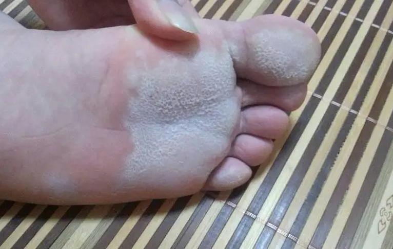 日本人如何处理脚气问题,欧美人为什么更容易患脚气