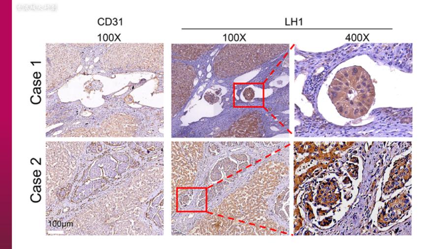香港治疗癌症突破,香港癌症治疗最新突破