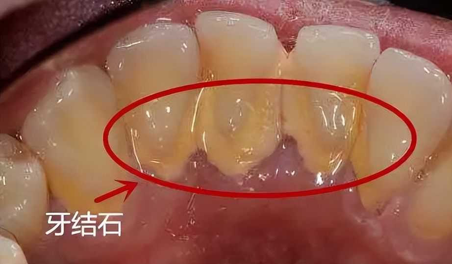 喉咙长结石的原因有哪些,喉咙里长结石吃什么药