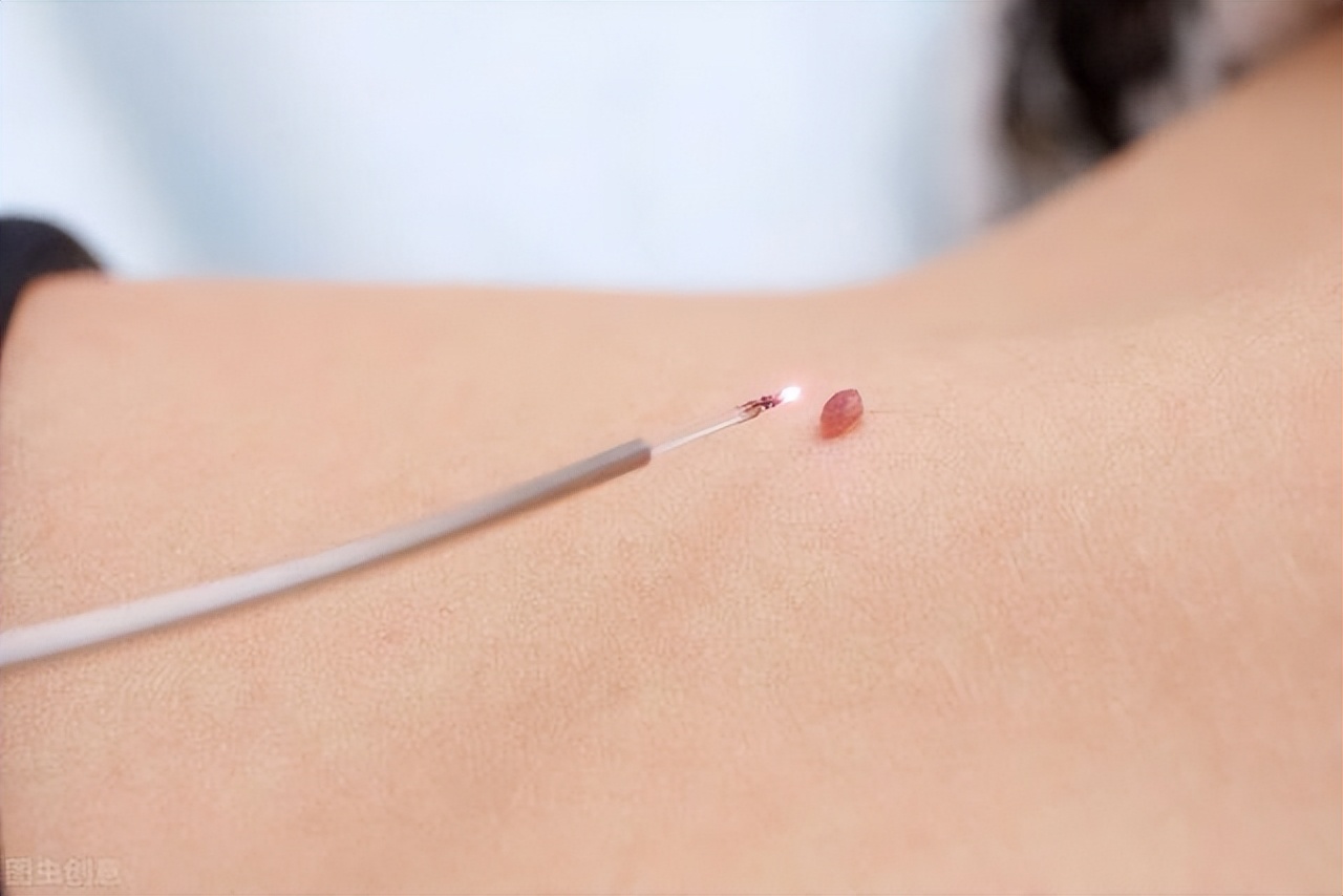 腋下的小肉粒可以揪掉吗,脖子上长的小肉粒可以揪掉吗