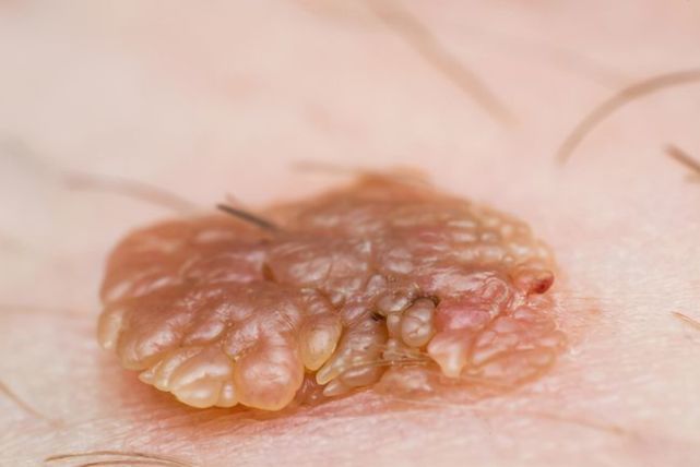 身上起红色小点点是不是hpv,身上有红色小血点跟hpv有关系吗