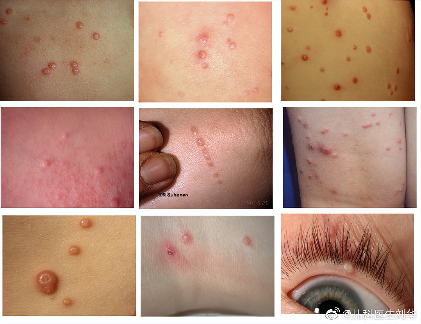 为什么小孩有那么多痘痘,儿童痘痘的最佳治疗方法