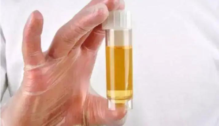 尿蛋白越高治疗好后复发几率越高,肾病尿蛋白高怎么办怎么能降下去