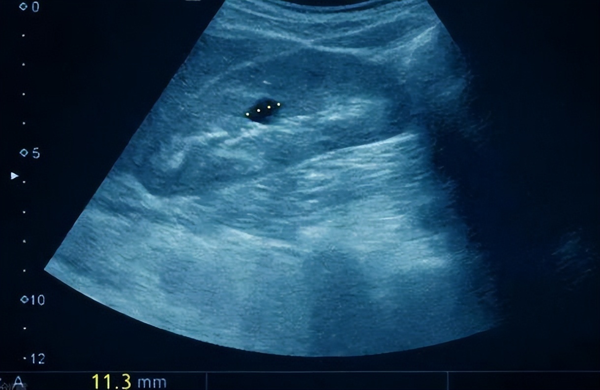 医生说有个囊肿是怎么回事,医生说囊肿是良性的但是需要手术