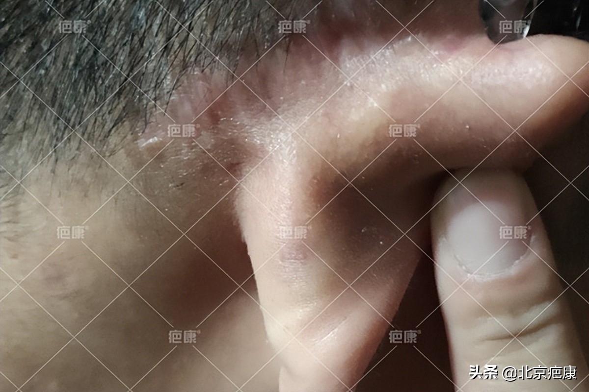 20岁小耳朵切除后恢复图片,耳朵增生疤痕疙瘩切除后要养多久