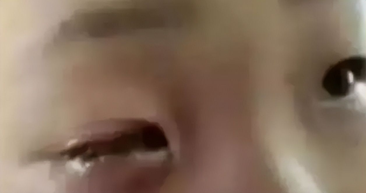 八岁男孩眼球被溶解,20分钟孩子眼球溶化无力回天