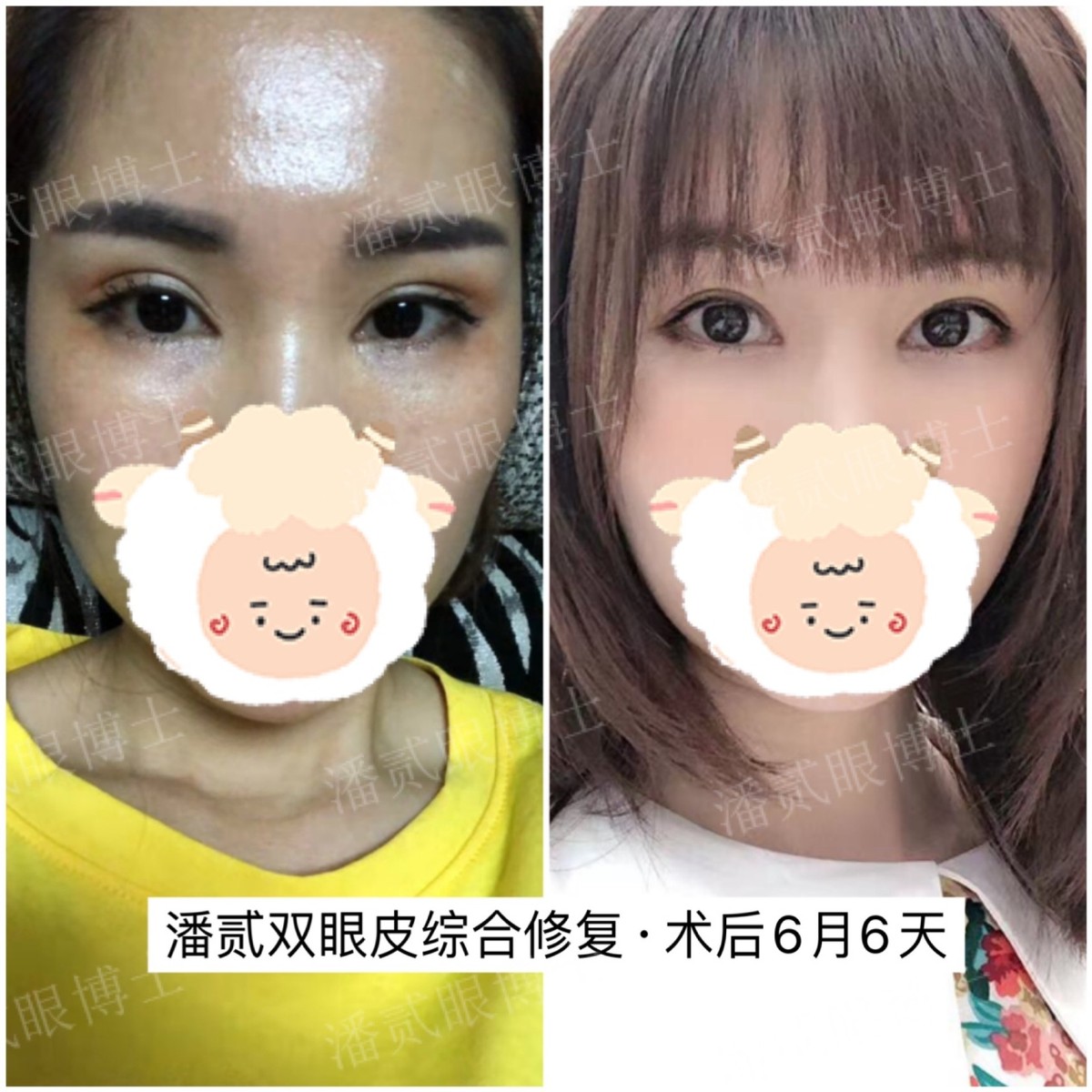 割双眼皮就割一只眼,割双眼皮提肌有风险吗