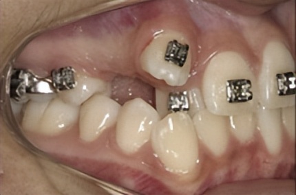 拔牙矫正后多长时间能合缝,拔牙矫正需要缝线吗