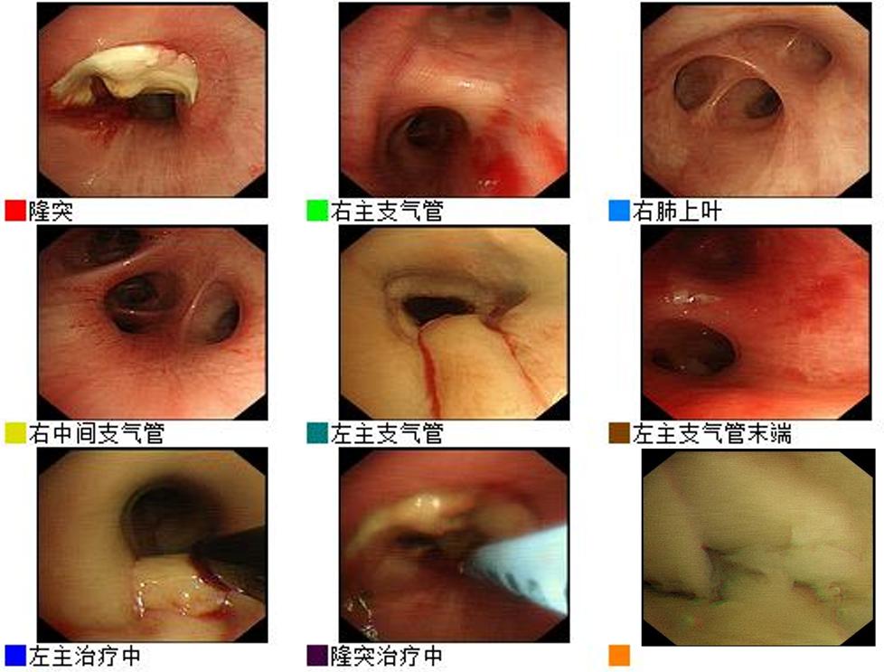 男23岁因上呼吸道感染剧烈咳嗽,34岁小伙咳嗽一个星期了