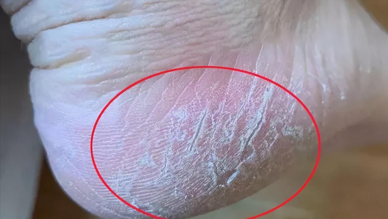 脚后跟干裂一般都是什么原因,脚后跟严重干裂是什么原因导致的
