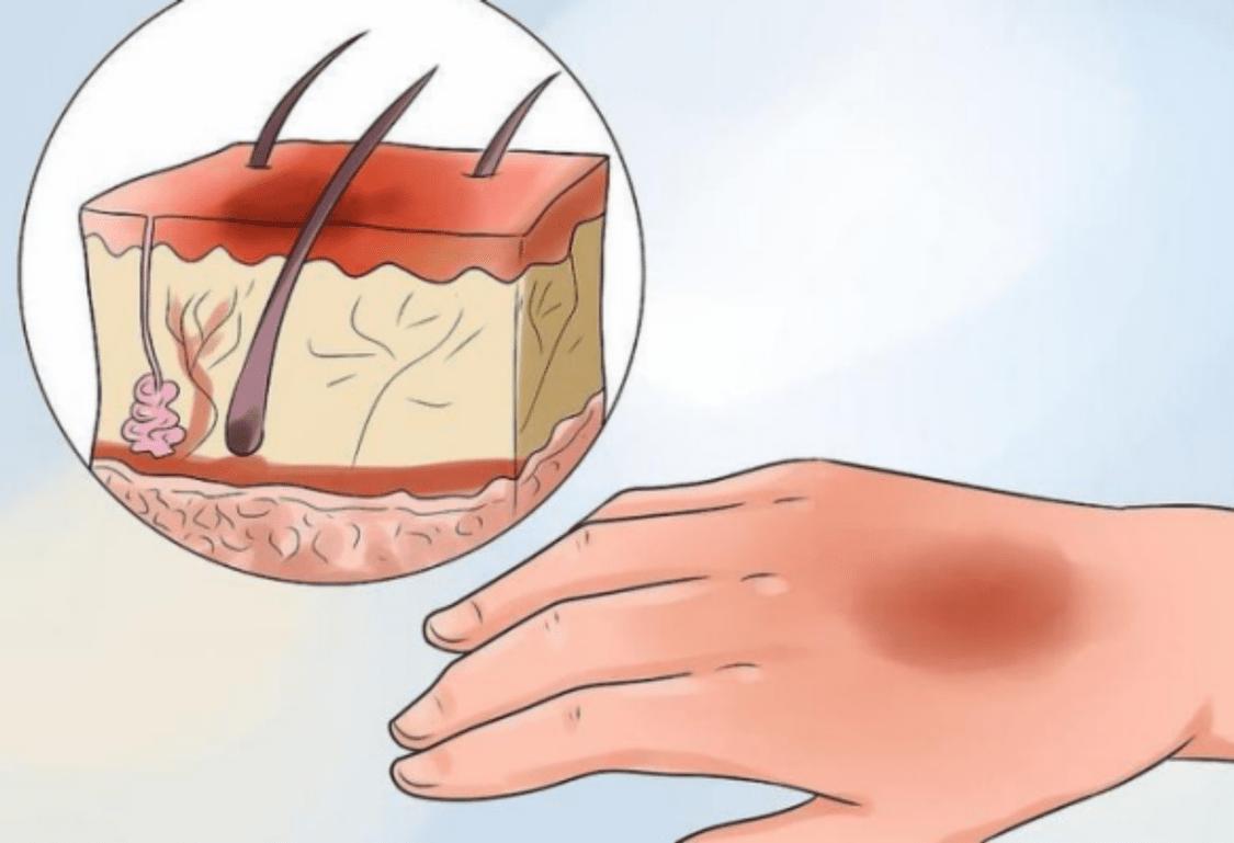 激光去除疤痕能改善到什么程度,激光祛除疤痕能改善到什么程度