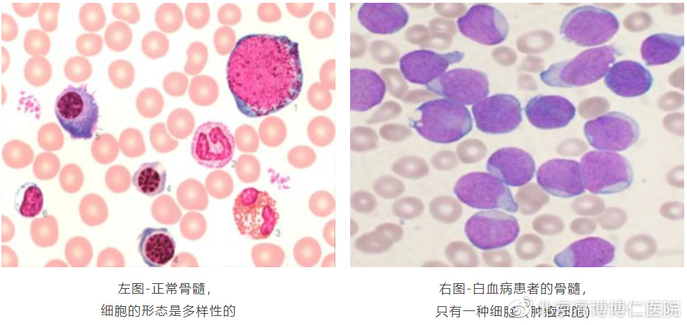 刘双又主任:白血病免疫靶向治疗异病同治,如何为患者创造新机遇