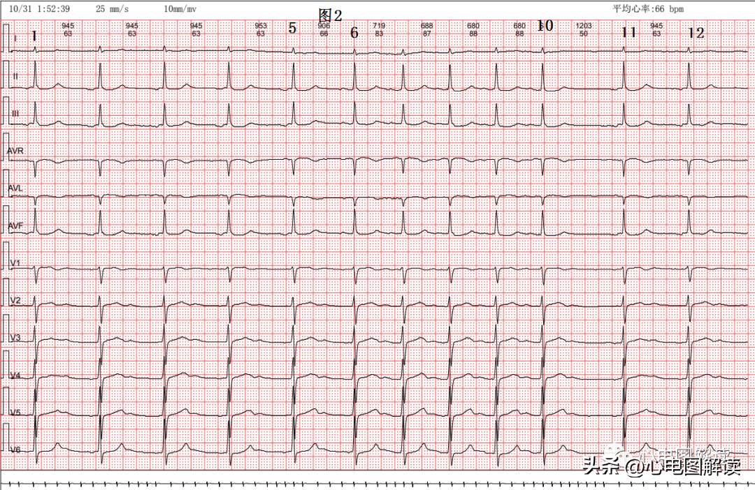 窦房结至心房之间的游走心律、房性心律的诱发原因之一
