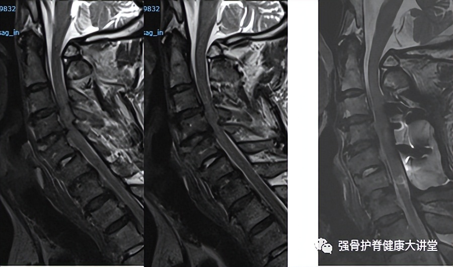 强直性脊柱炎有骨折怎样治疗,强直性脊柱炎容易误诊吗