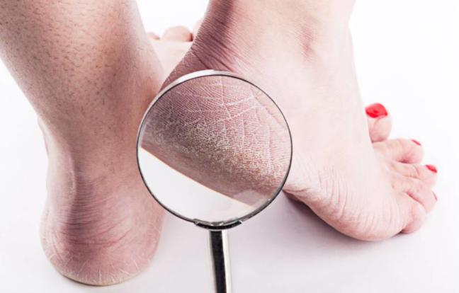 脚后跟干裂可能和这4个原因有关,脚后跟经常干裂什么原因