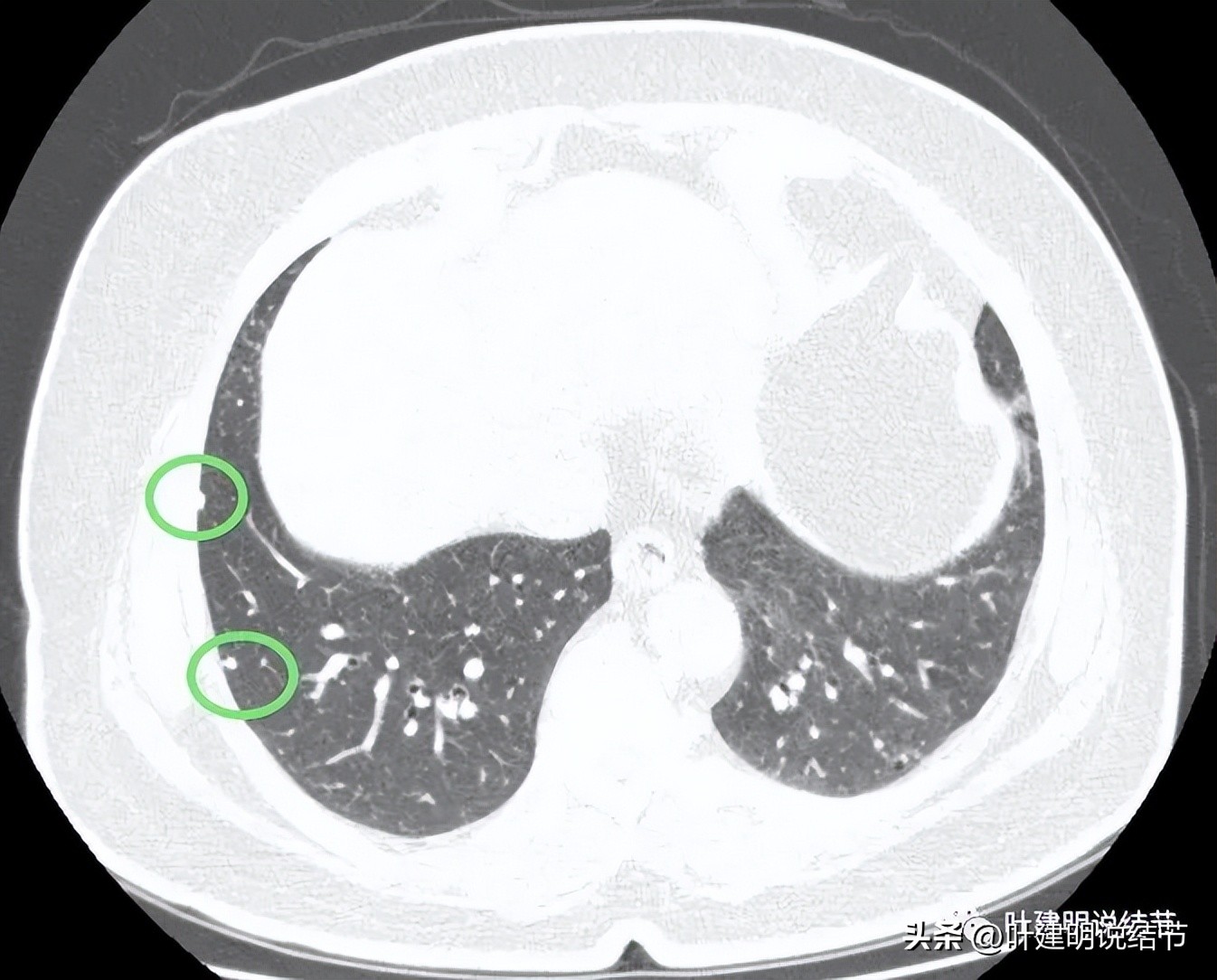 肺结节实性为什么建议抗炎治疗,肺上实性结节抗炎后变成空洞