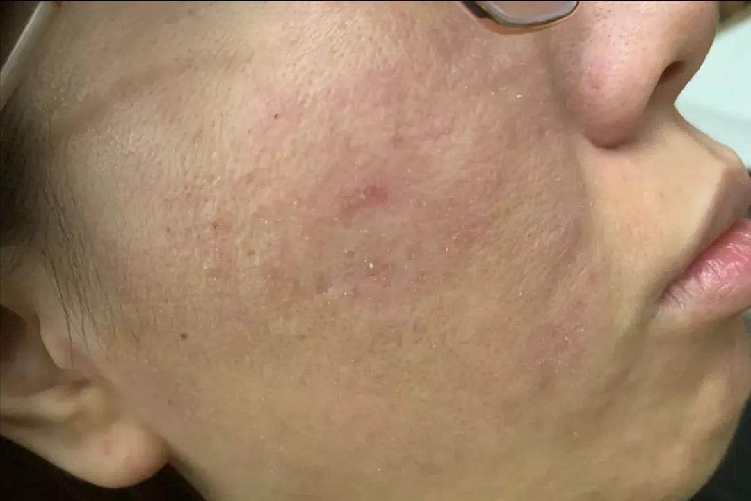 面部皮炎是怎么引起的,面部皮炎是炎症吗