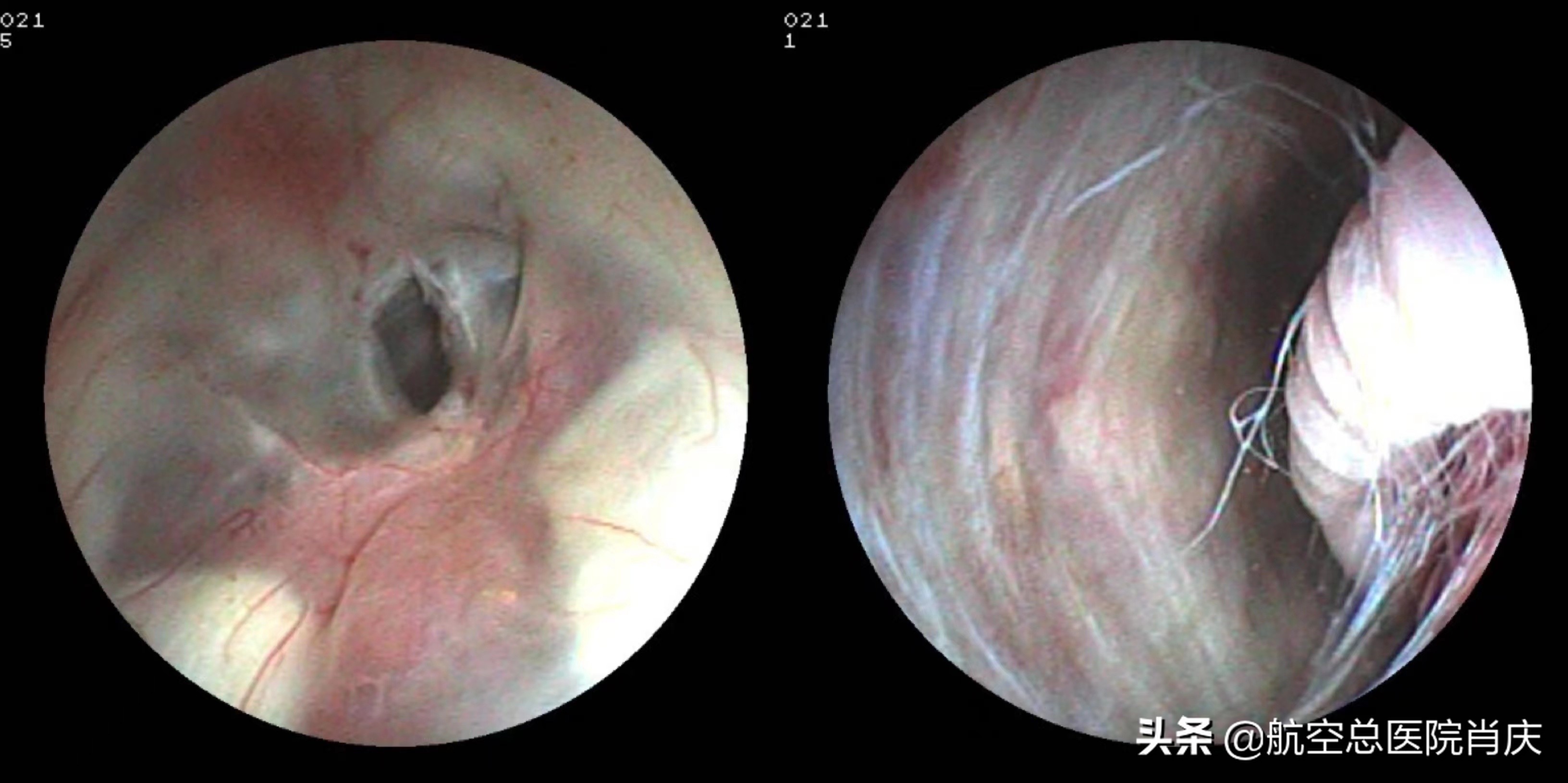 3天半昏迷脑积水能痊愈吗,脑积水适合什么内镜