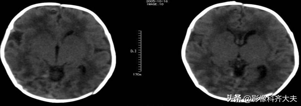 新生儿缺氧缺血性脑病的mr诊断,新生儿缺血缺氧脑病的ct表现