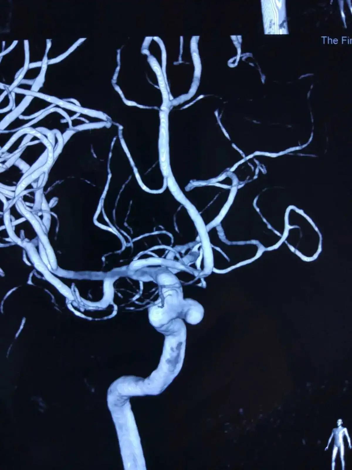 不明原因的眼皮耷拉下垂,可能是这个可怕的病