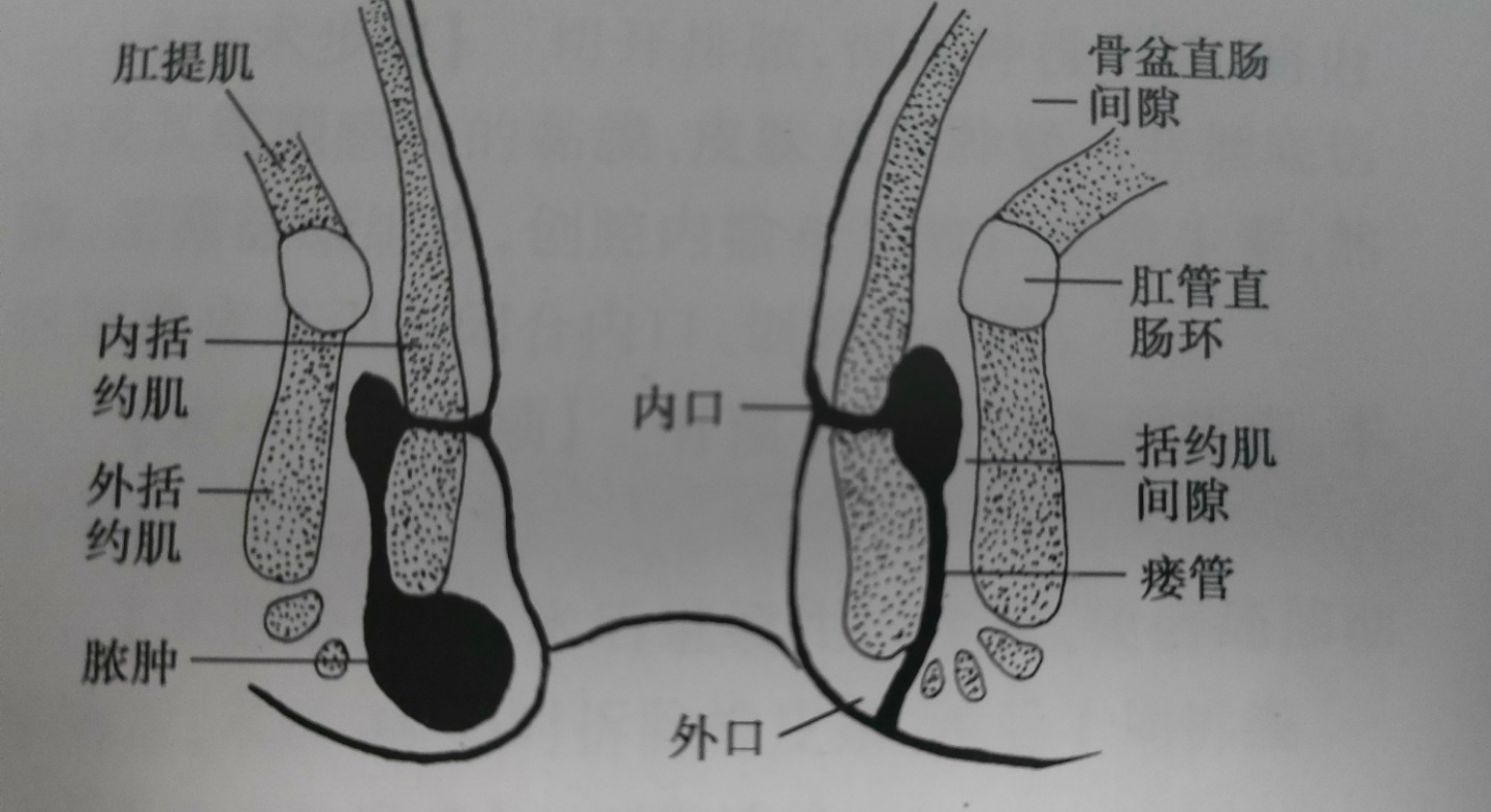 为什么有些人肛瘘一个星期就好了,为什么有的肛瘘术后不需要换药