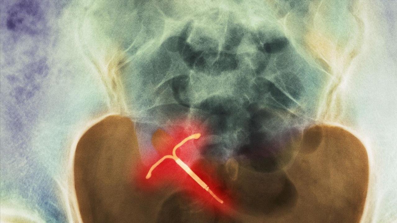 女性取出节育环后多久可以怀孕,节育环在体内有年限吗