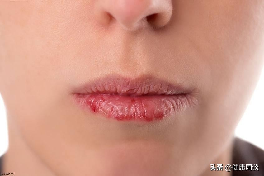 为什么唇炎会反反复复,为什么唇炎会反复发作